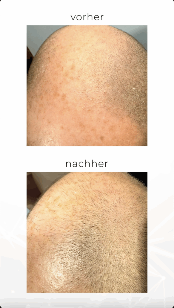 Futurahair Vorher nachher 2 Futurahair Vorher nachher 2