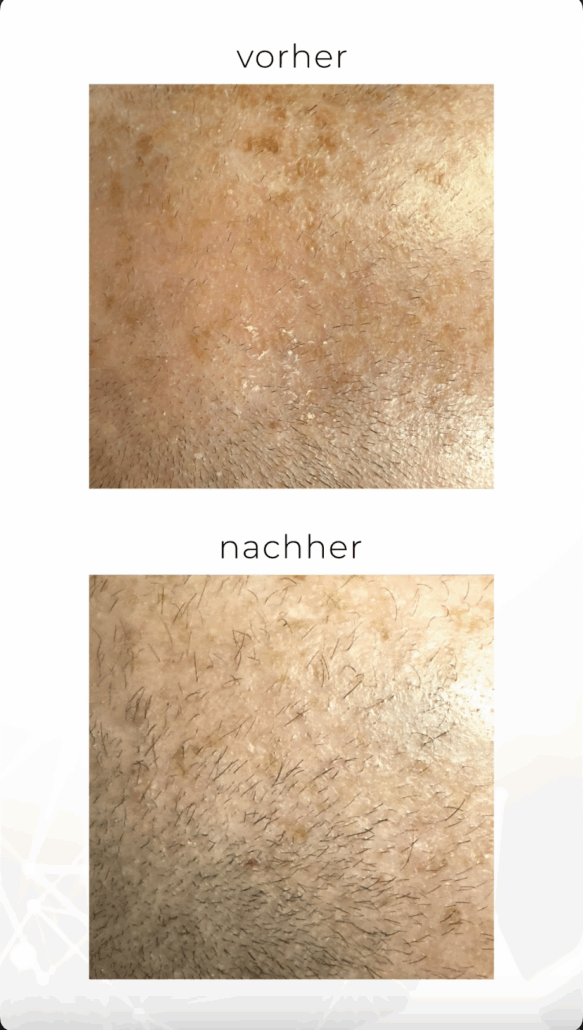 Futurahair Vorher nachher 1 Futurahair Vorher nachher 1