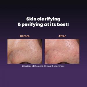 DermaClear Vorher Nachher 2 DermaClear Vorher Nachher 2